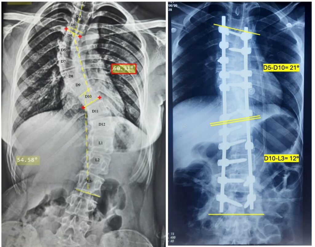 ADVANCED SCOLIOSIS AND DEFORMITY COURSE joined by AOSYS Research and Training Foundation
